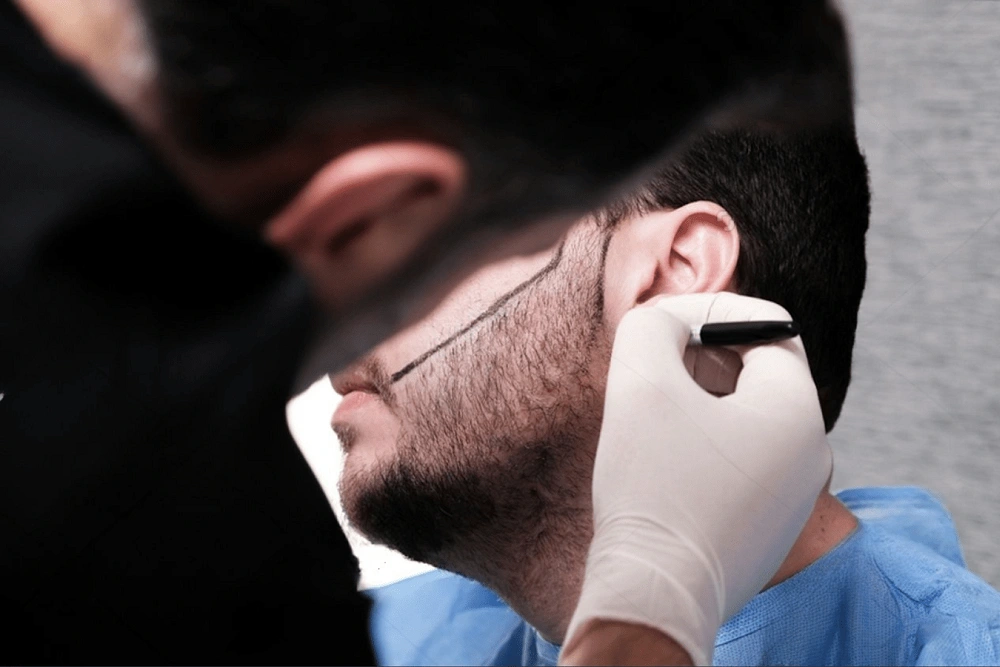 راهنمای کامل مشاوره کاشت ریش: نکات، مراحل و توصیه‌های متخصصان