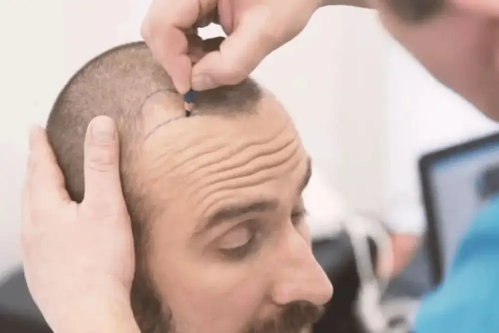 مشاوره آنلاین کاشت مو با متخصص پوست و مو و بررسی شرایط، روش‌ها و هزینه