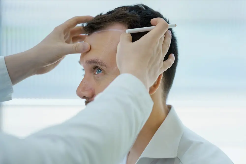 بررسی انتظارات واقع‌بینانه در مشاوره کاشت مو
